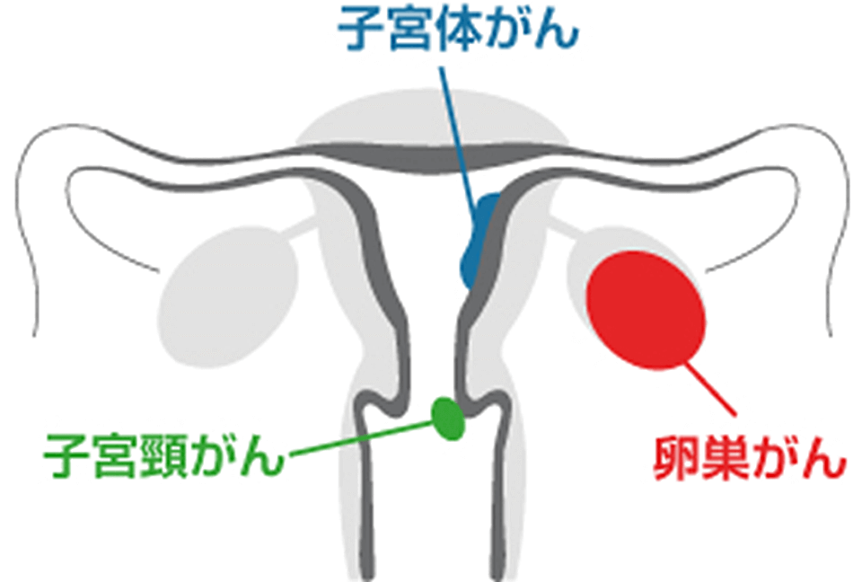 がんの種類